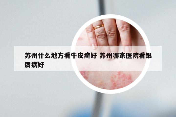 苏州什么地方看牛皮癣好 苏州哪家医院看银屑病好