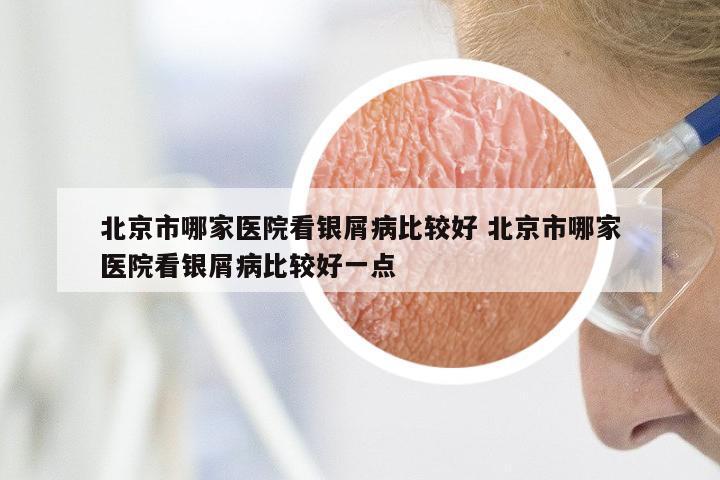 北京市哪家医院看银屑病比较好 北京市哪家医院看银屑病比较好一点
