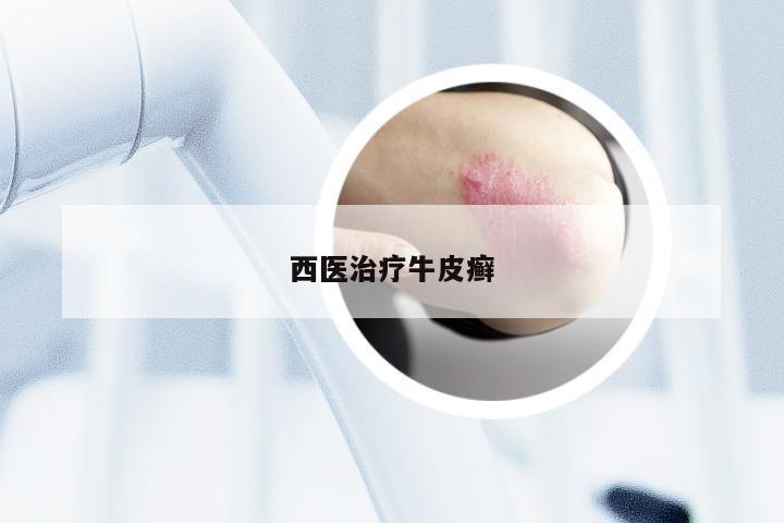 西医治疗牛皮癣