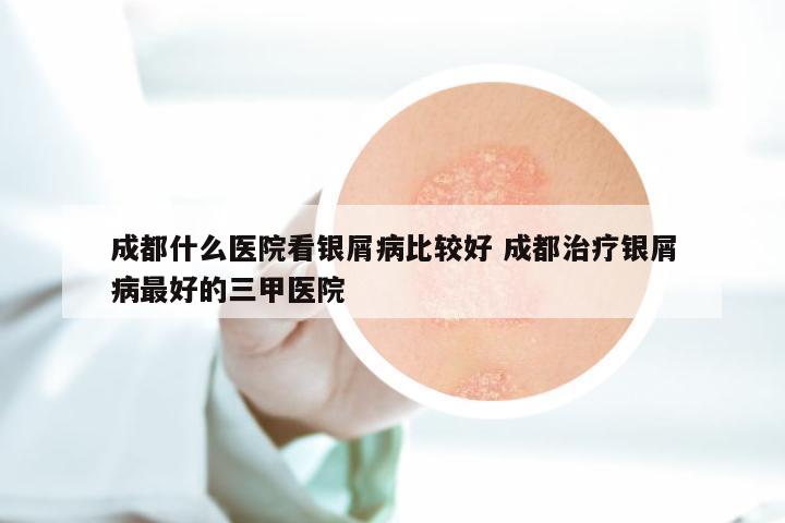 成都什么医院看银屑病比较好 成都治疗银屑病最好的三甲医院