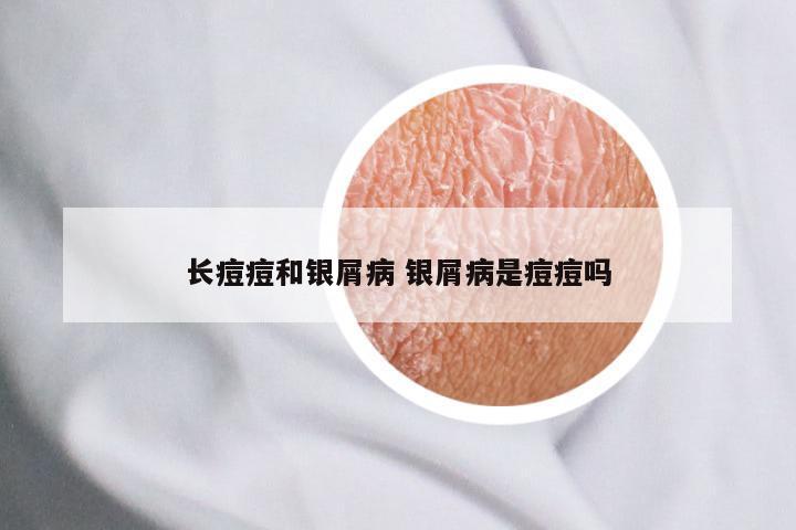 长痘痘和银屑病 银屑病是痘痘吗