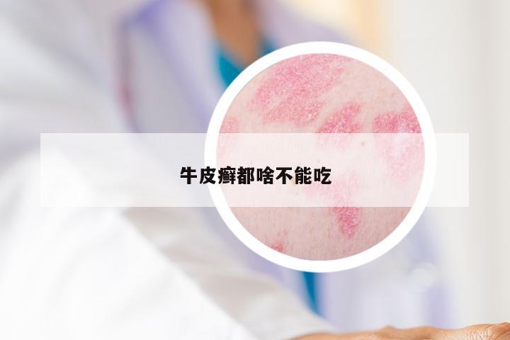 牛皮癣都啥不能吃