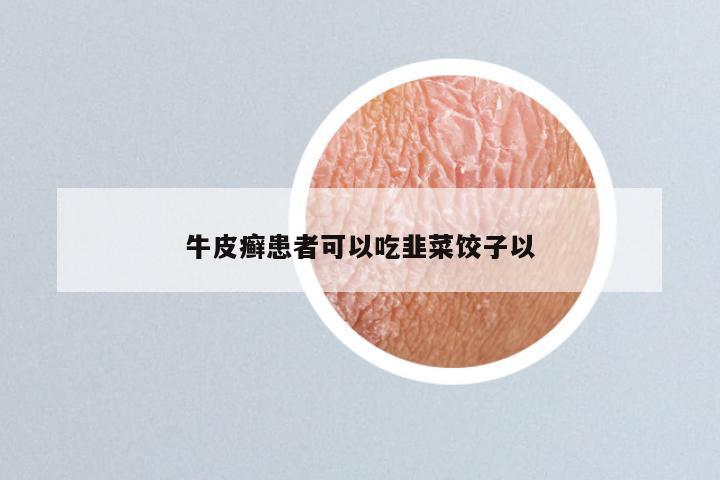 牛皮癣患者可以吃韭菜饺子以