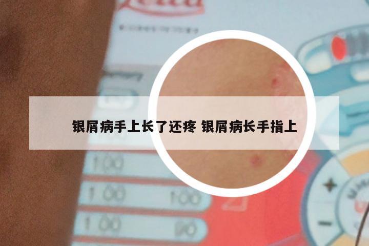 银屑病手上长了还疼 银屑病长手指上