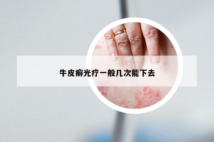 牛皮癣光疗一般几次能下去