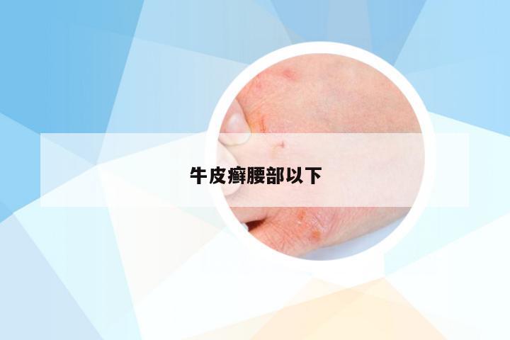 牛皮癣腰部以下