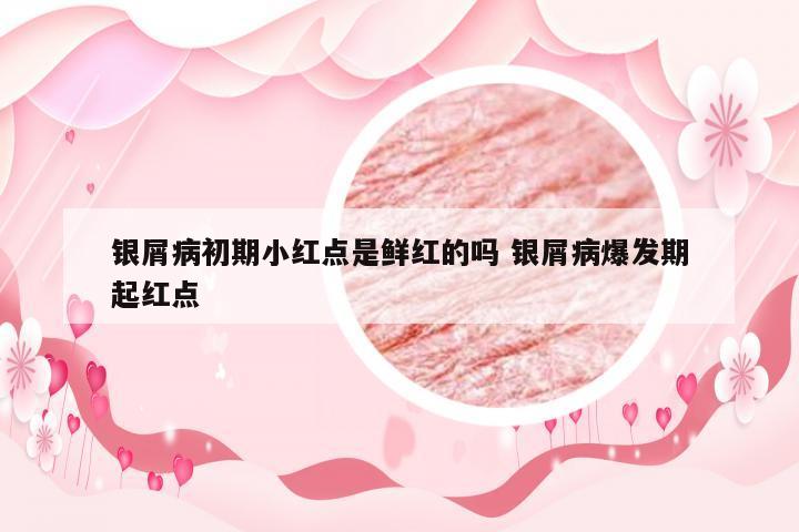 银屑病初期小红点是鲜红的吗 银屑病爆发期起红点