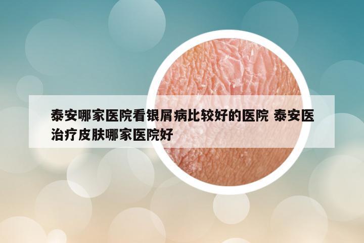 泰安哪家医院看银屑病比较好的医院 泰安医治疗皮肤哪家医院好