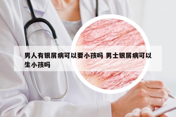 男人有银屑病可以要小孩吗 男士银屑病可以生小孩吗