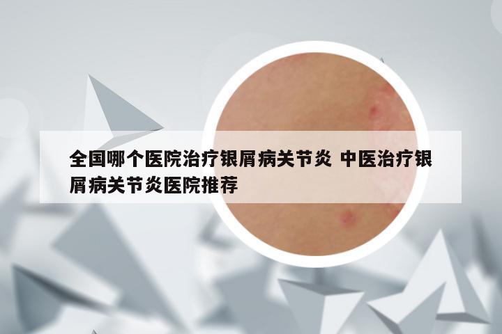 全国哪个医院治疗银屑病关节炎 中医治疗银屑病关节炎医院推荐