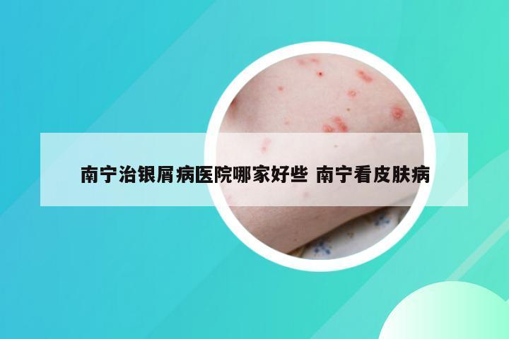 南宁治银屑病医院哪家好些 南宁看皮肤病