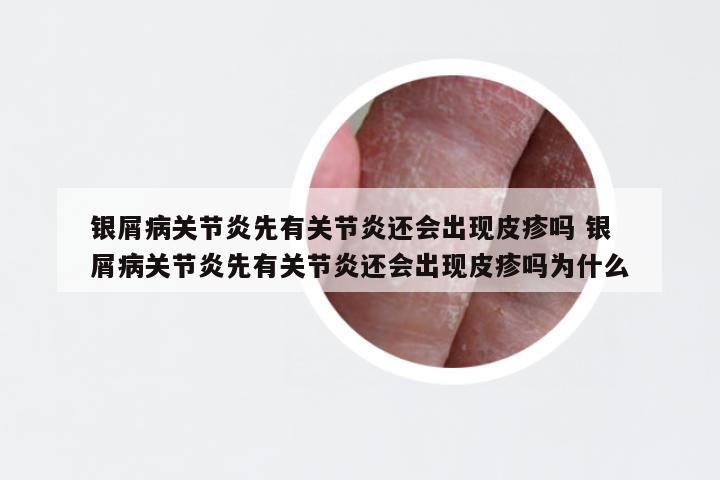 银屑病关节炎先有关节炎还会出现皮疹吗 银屑病关节炎先有关节炎还会出现皮疹吗为什么