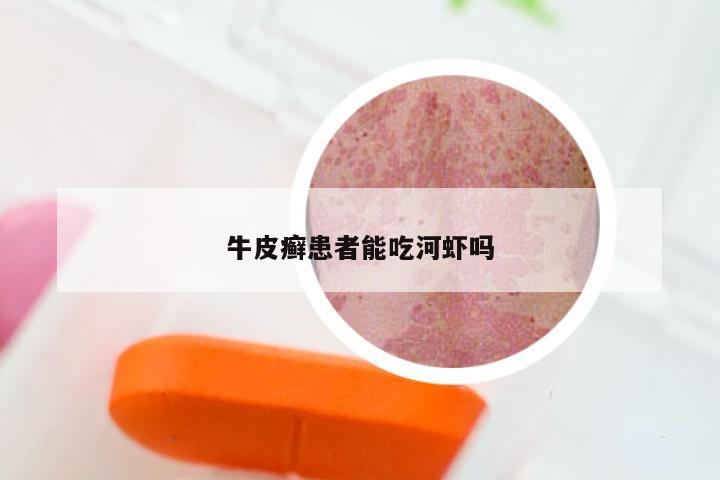 牛皮癣患者能吃河虾吗