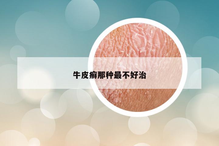 牛皮癣那种最不好治