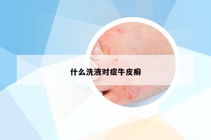 什么洗液对症牛皮癣