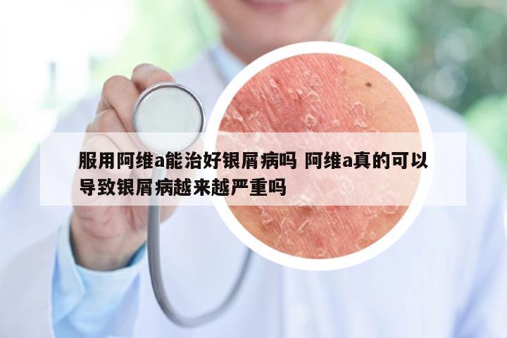 服用阿维a能治好银屑病吗 阿维a真的可以导致银屑病越来越严重吗