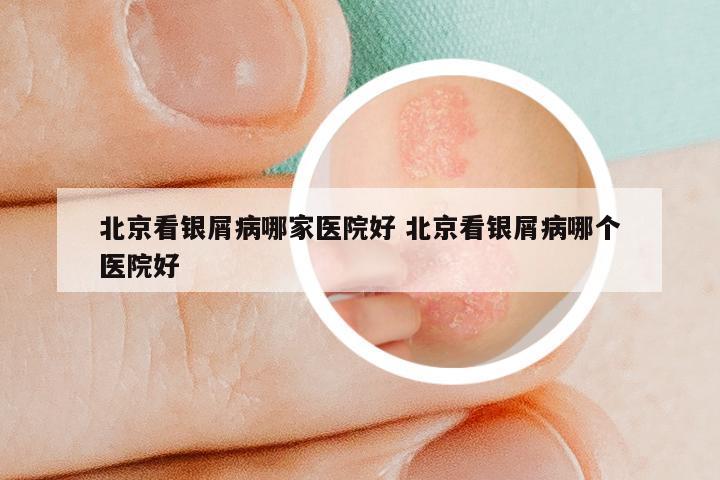 北京看银屑病哪家医院好 北京看银屑病哪个医院好