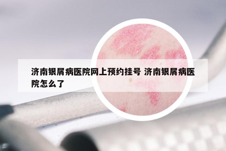 济南银屑病医院网上预约挂号 济南银屑病医院怎么了