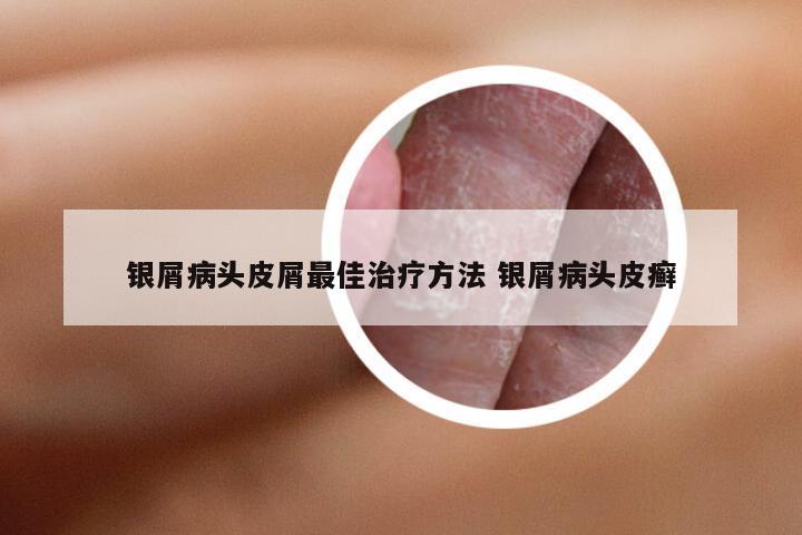 银屑病头皮屑最佳治疗方法 银屑病头皮癣