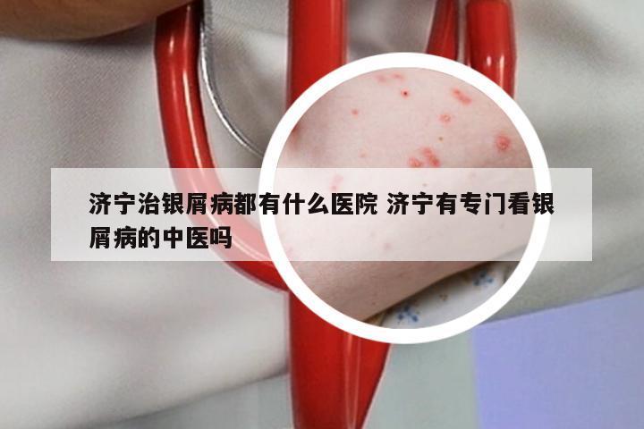 济宁治银屑病都有什么医院 济宁有专门看银屑病的中医吗