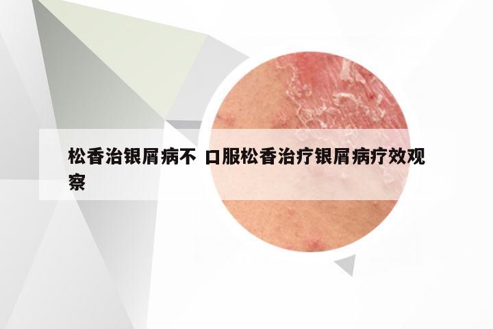 松香治银屑病不 口服松香治疗银屑病疗效观察