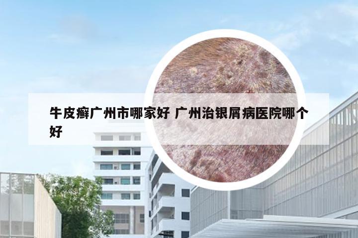 牛皮癣广州市哪家好 广州治银屑病医院哪个好
