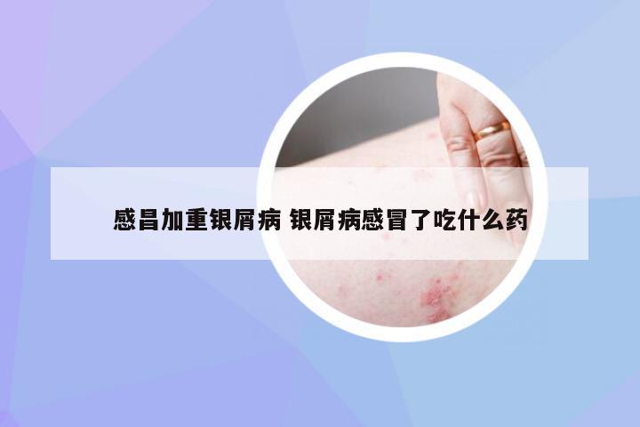 感昌加重银屑病 银屑病感冒了吃什么药