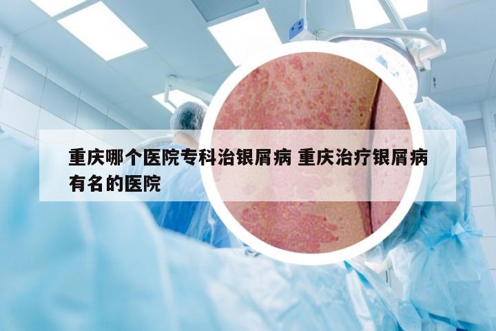 重庆哪个医院专科治银屑病 重庆治疗银屑病有名的医院