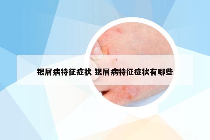 银屑病特征症状 银屑病特征症状有哪些