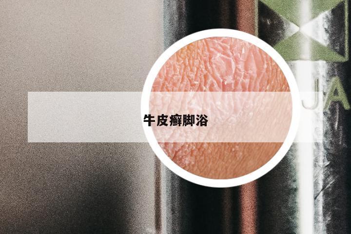 牛皮癣脚浴