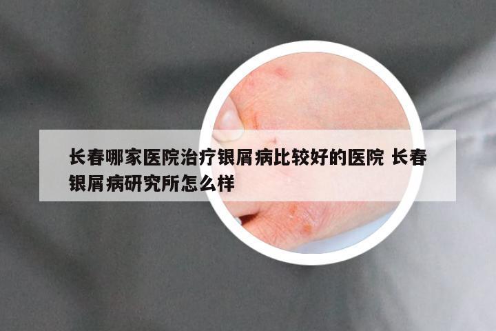 长春哪家医院治疗银屑病比较好的医院 长春银屑病研究所怎么样