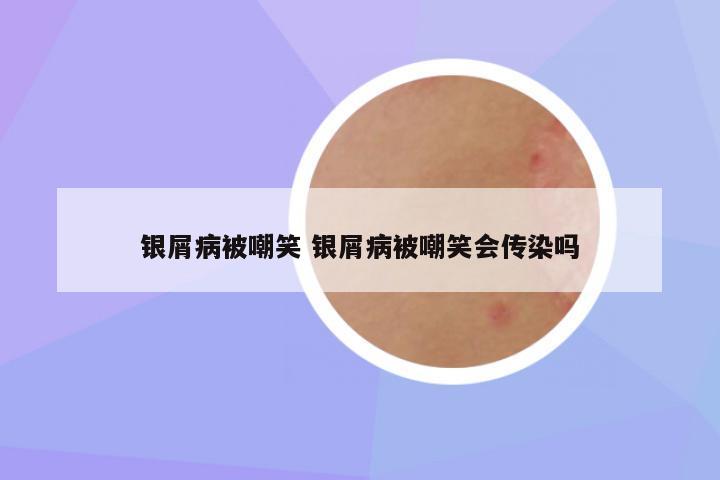 银屑病被嘲笑 银屑病被嘲笑会传染吗
