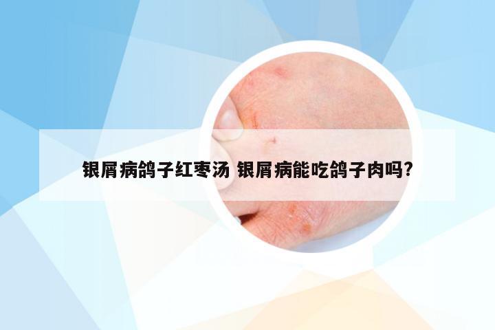 银屑病鸽子红枣汤 银屑病能吃鸽子肉吗?