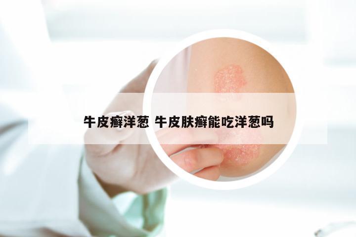 牛皮癣洋葱 牛皮肤癣能吃洋葱吗
