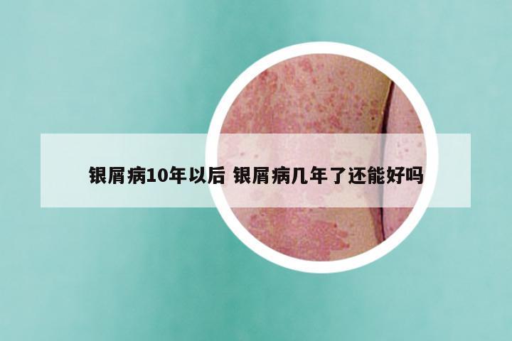银屑病10年以后 银屑病几年了还能好吗