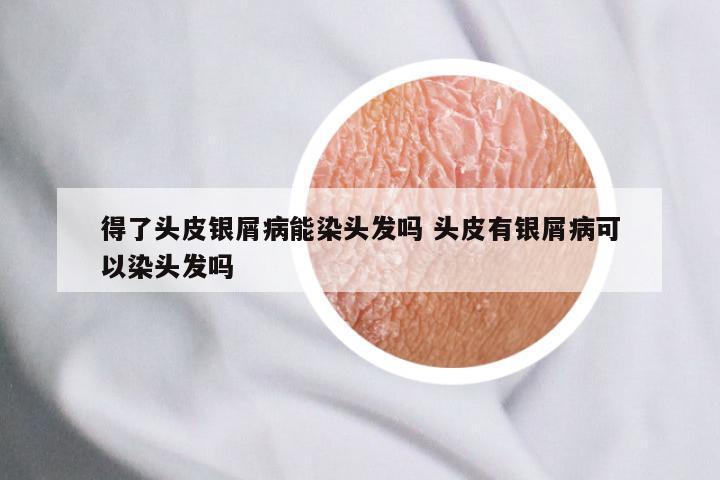 得了头皮银屑病能染头发吗 头皮有银屑病可以染头发吗