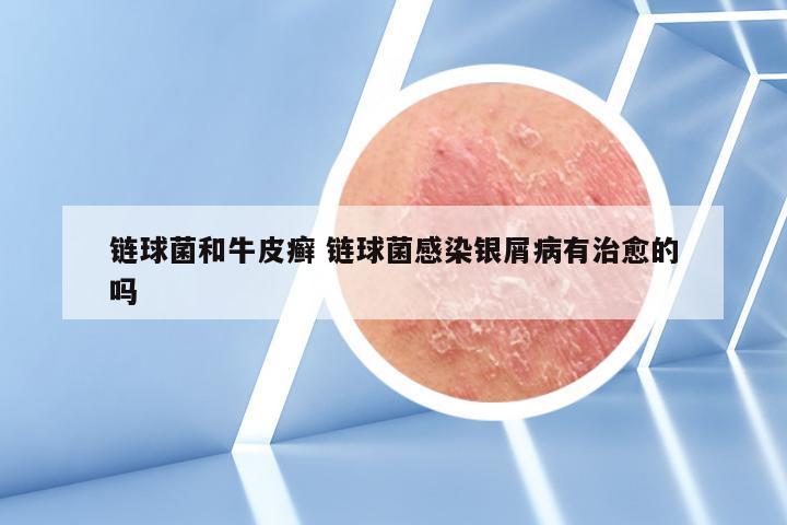 链球菌和牛皮癣 链球菌感染银屑病有治愈的吗