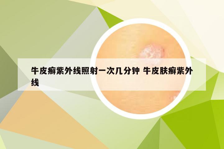 牛皮癣紫外线照射一次几分钟 牛皮肤癣紫外线