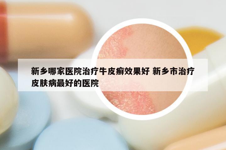 新乡哪家医院治疗牛皮癣效果好 新乡市治疗皮肤病最好的医院