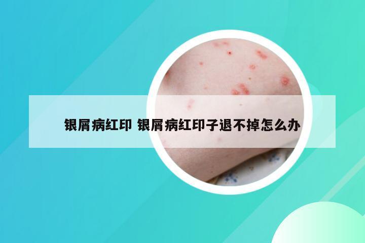 银屑病红印 银屑病红印子退不掉怎么办