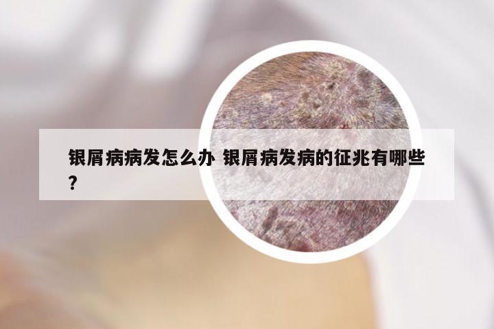 银屑病病发怎么办 银屑病发病的征兆有哪些?