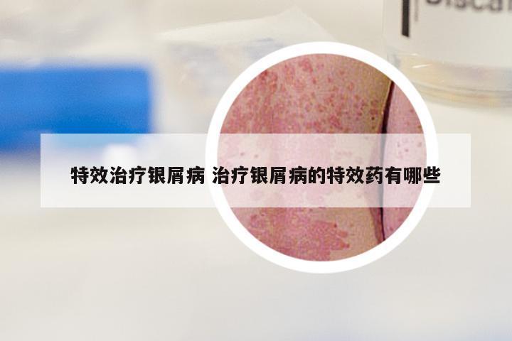特效治疗银屑病 治疗银屑病的特效药有哪些
