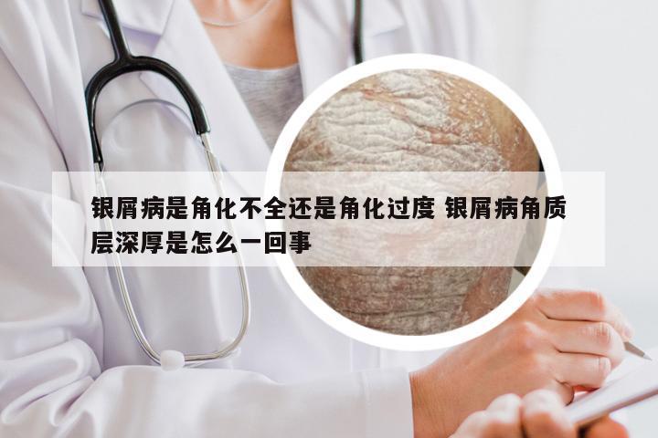 银屑病是角化不全还是角化过度 银屑病角质层深厚是怎么一回事