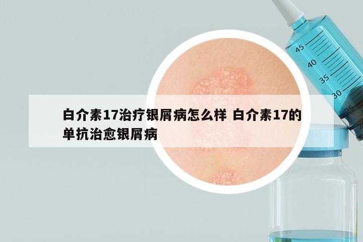 白介素17治疗银屑病怎么样 白介素17的单抗治愈银屑病