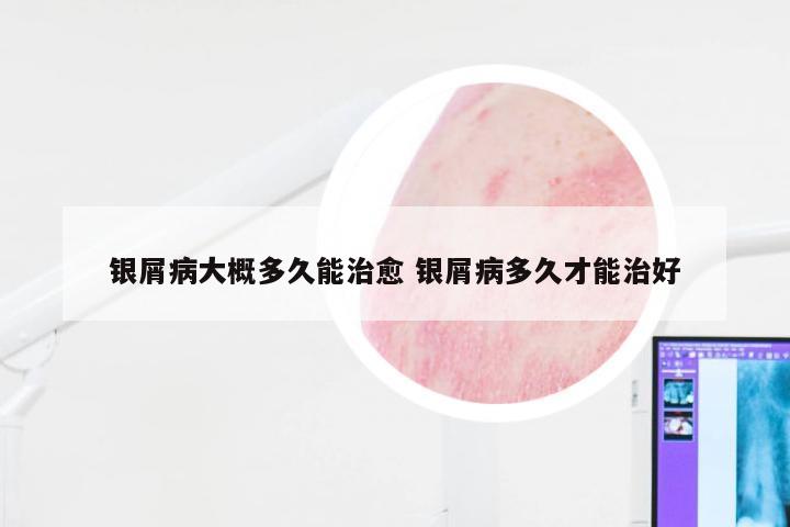 银屑病大概多久能治愈 银屑病多久才能治好