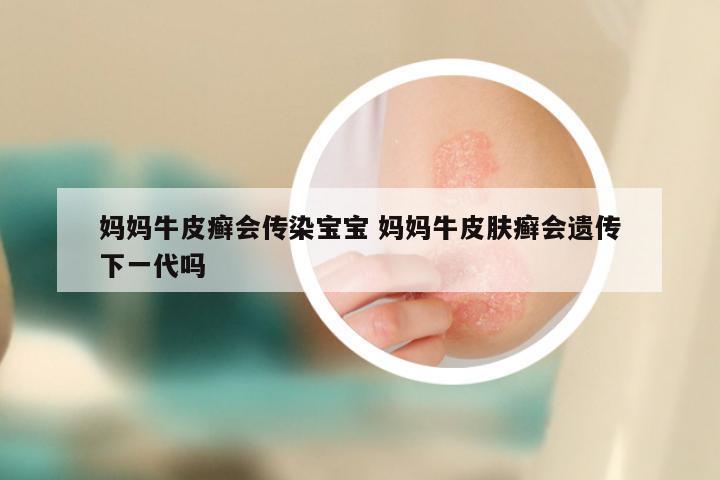 妈妈牛皮癣会传染宝宝 妈妈牛皮肤癣会遗传下一代吗