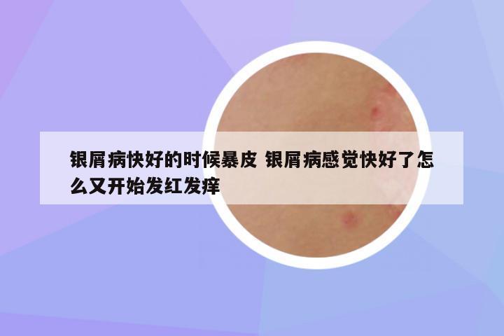 银屑病快好的时候暴皮 银屑病感觉快好了怎么又开始发红发痒