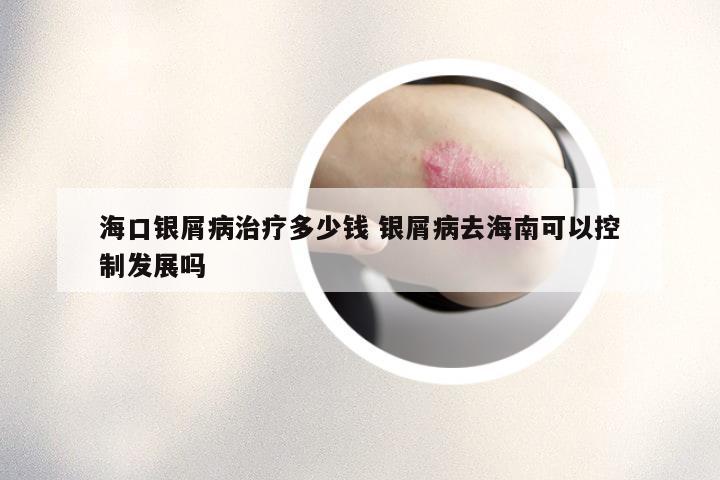 海口银屑病治疗多少钱 银屑病去海南可以控制发展吗