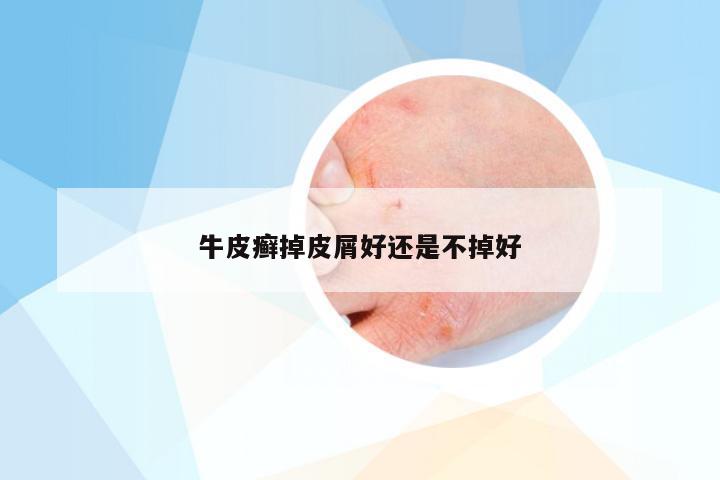 牛皮癣掉皮屑好还是不掉好