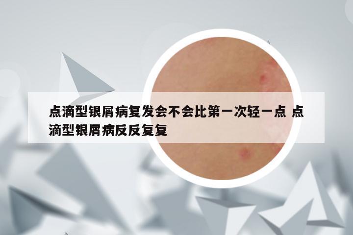 点滴型银屑病复发会不会比第一次轻一点 点滴型银屑病反反复复